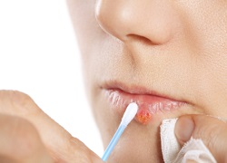 fast cold sore treatment for cold sores
